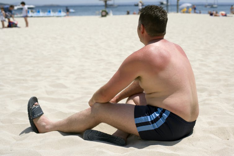 A man with sunburned shoulders sitting on a beach.