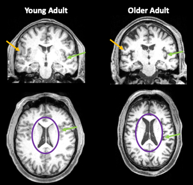 Brain scans from a person in their 30s and a person in their 80s, showing reduced brain volume in the older adult brain