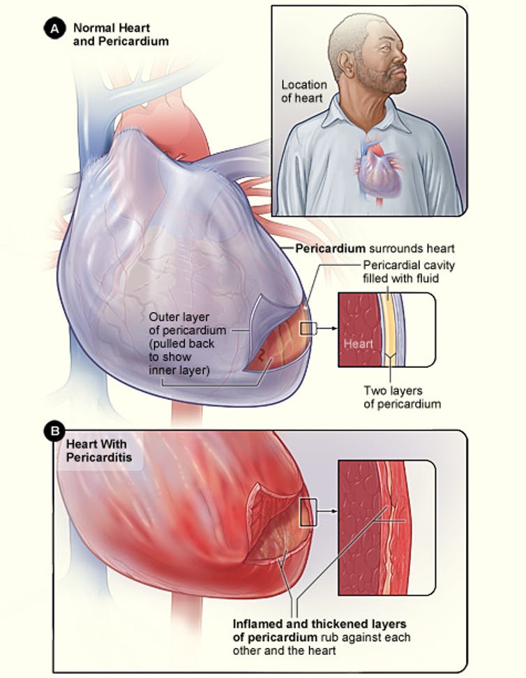 Illustration of a heart showing pericarditis
