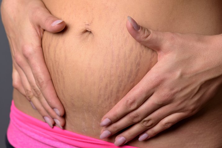 Midsection Of Woman With Stretch Marks On Abdomen