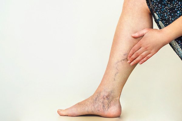 How to Get Rid of Varicose Veins | If you have mild to moderate varicose veins, this post has lots of great information to help you determine the best treatment for you. From knowing the symptoms and causes of varicose veins, to understanding how to prevent varicose veins from getting worse, to home remedies and natural treatments, we're sharing lifestyle changes, exercises, yoga poses, essential oils, and many other DIY treatment options for fast relief.